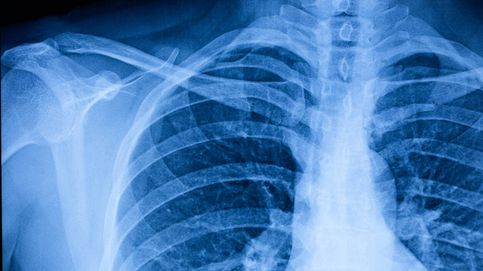 Pulmones de piedra: el avance que da esperanza a los pacientes de fibrosis pulmonar
