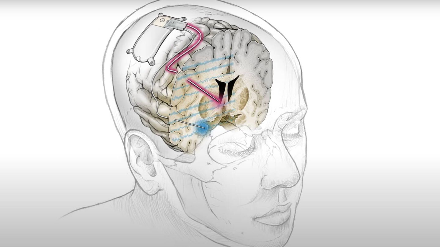 Ejemplo de un implante cerebral de otro proyecto. 
