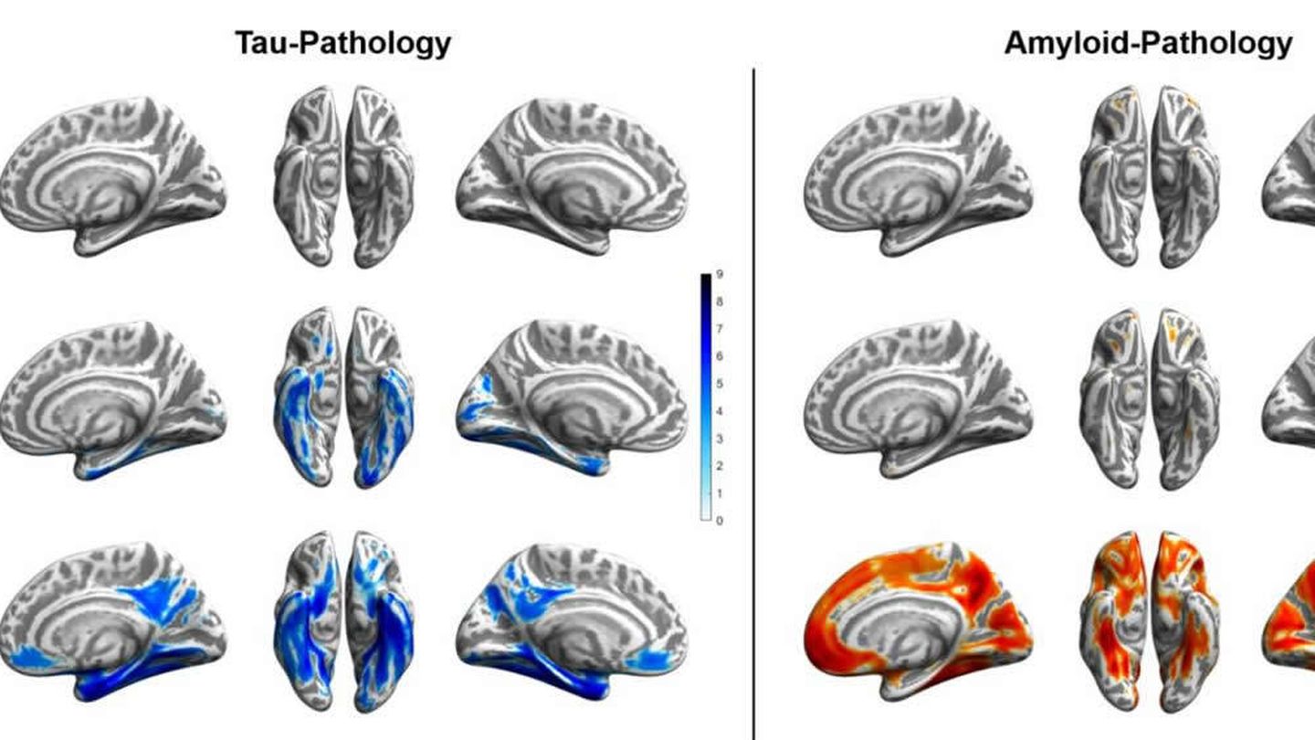 Imagen que muestra la diferente acumulación de tau y amiloide en diferentes tipos de cerebro. Foto:  Merle Hoenig.