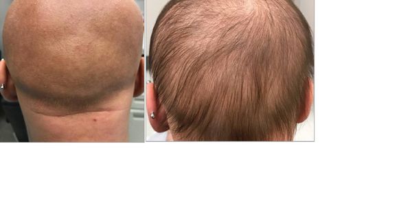 Foto: El antes y el después en la cabeza de la adolescente (JAMA Dermatology)