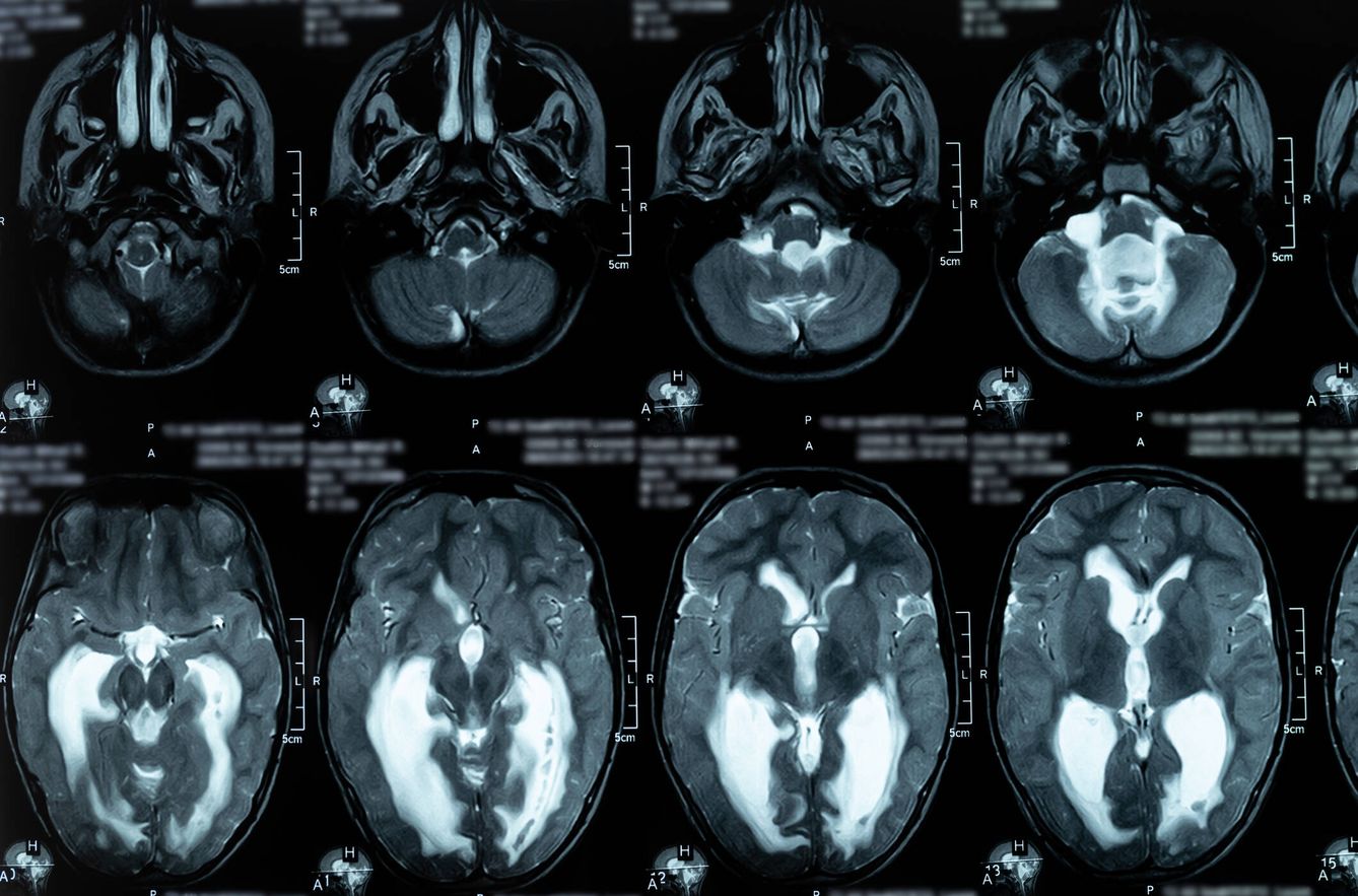 Resonancia magnética del cerebro que muestra hidrocefalia triventricular obstructiva. (iStock)