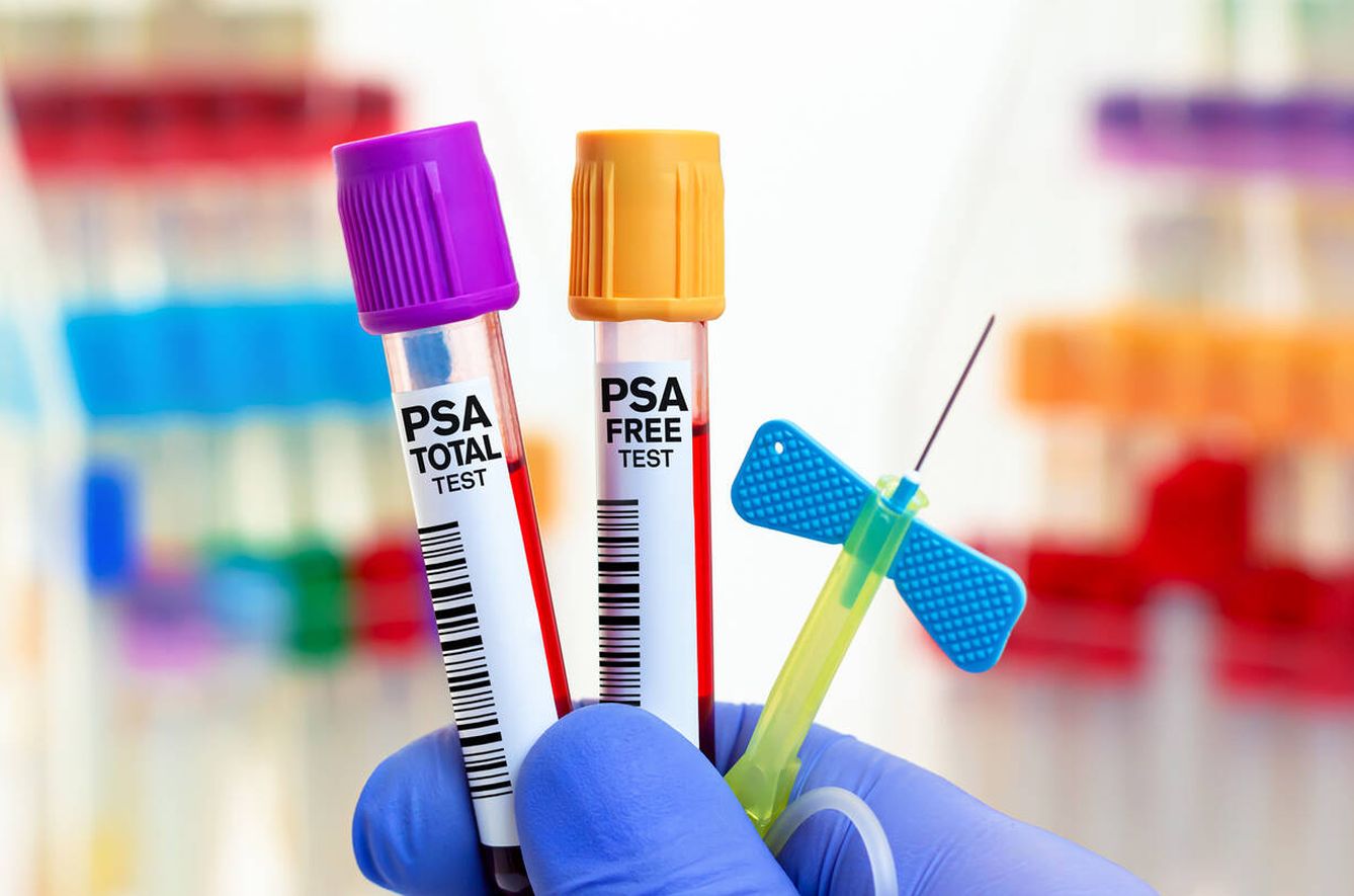 La determinación del PSA es un test rutinario para detectar cáncer de próstata. (iStock)