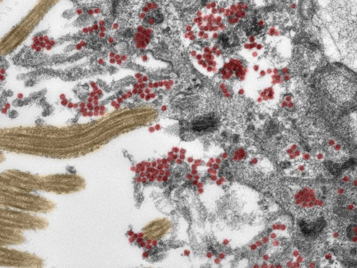 Foto: Mucosa olfativa con coronavirus. (Hospital universitario Charité de Berlín)