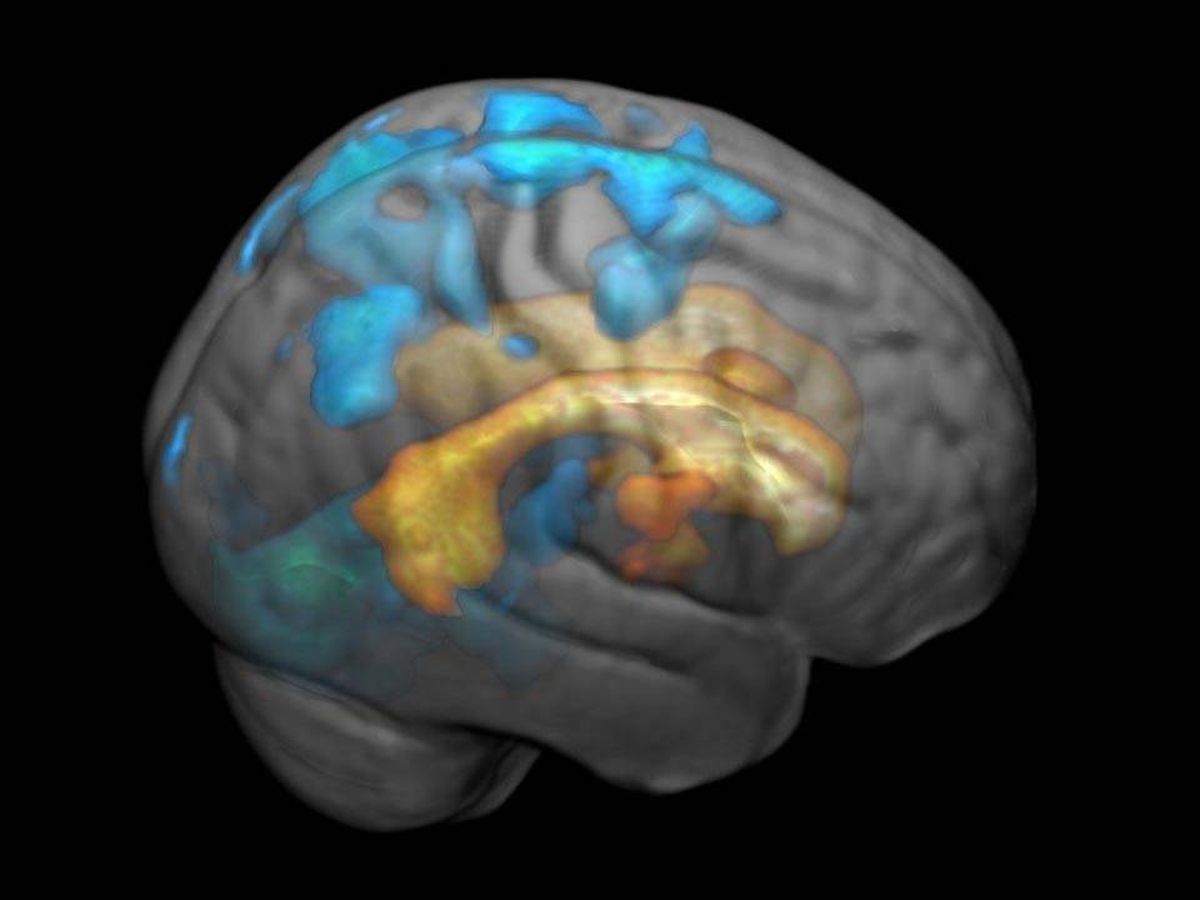 Foto: Proliferación de manchas blancas en el cerebro. Foto: Universidad Noruega de Ciencia y Tecnología