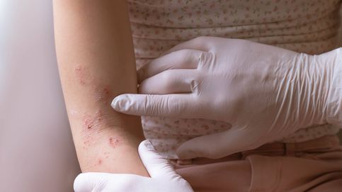 Crean una alternativa para aliviar la dermatitis sin fármacos 