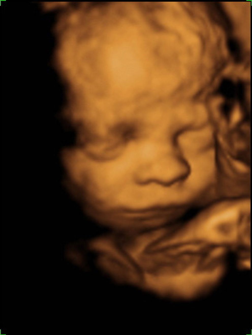 Foto: La ecografía en 3D, mucho más que la cara de su bebé