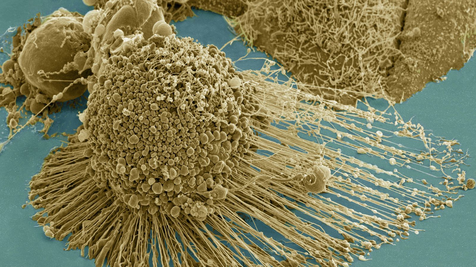 Foto: Micrografía electrónica de barrido de una célula HeLa apoptótica. (NIH)