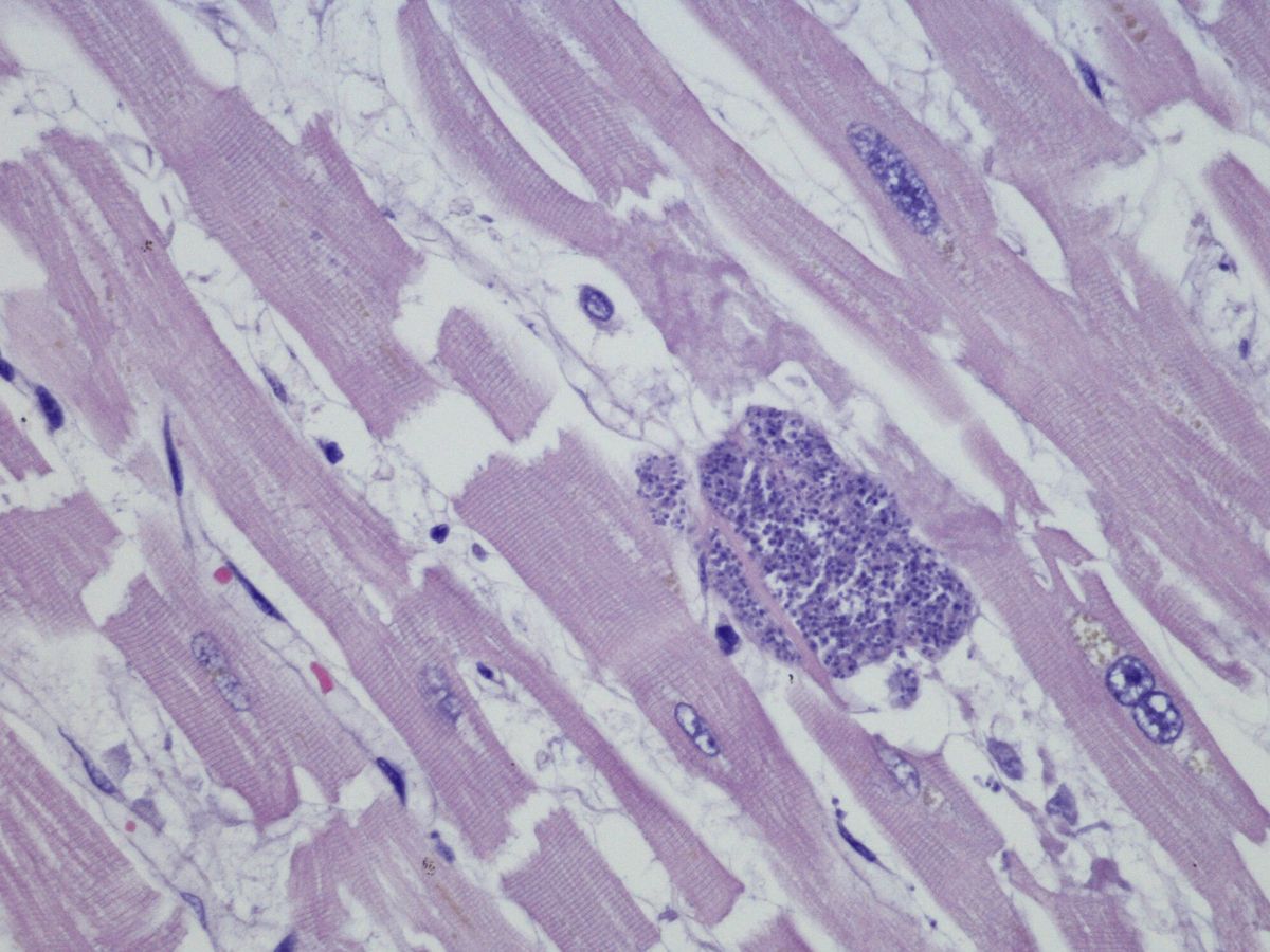 Foto: Micrografía de la toxoplasmosis miocárdica. (iStock)