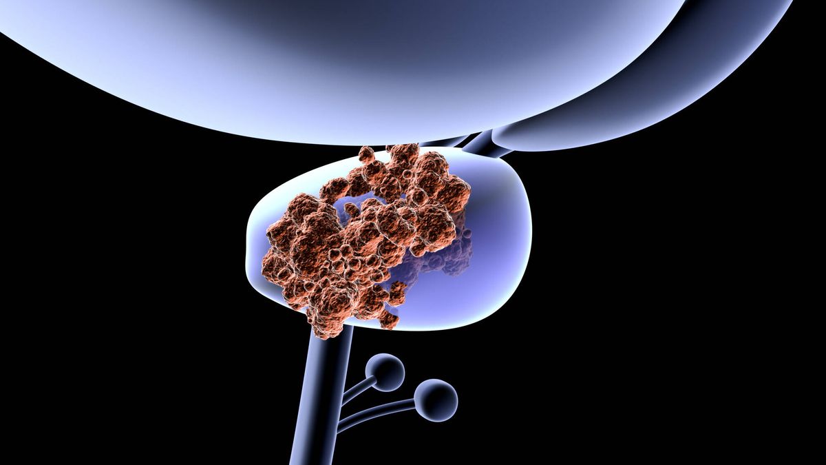 La terapia que destruye el cáncer de próstata en el 85% de los pacientes