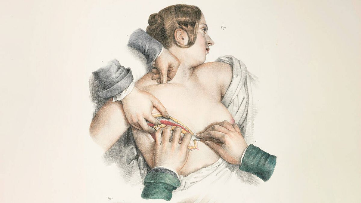 "¿Quién me sostendrá el pecho?": cómo Fanny Burney narró su propia mastectomía en 1811
