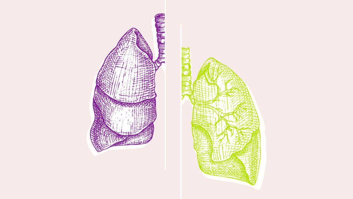 Cáncer de pulmón: de un diagnóstico tardío  a una larga supervivencia