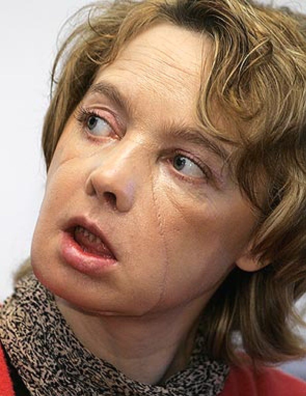 Foto: Autorizan el primer transplante de cara en España