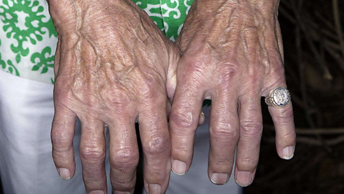 Las manos de una superviviente de Pearl Harbour, ejemplo de manos estriadas.  (Getty)