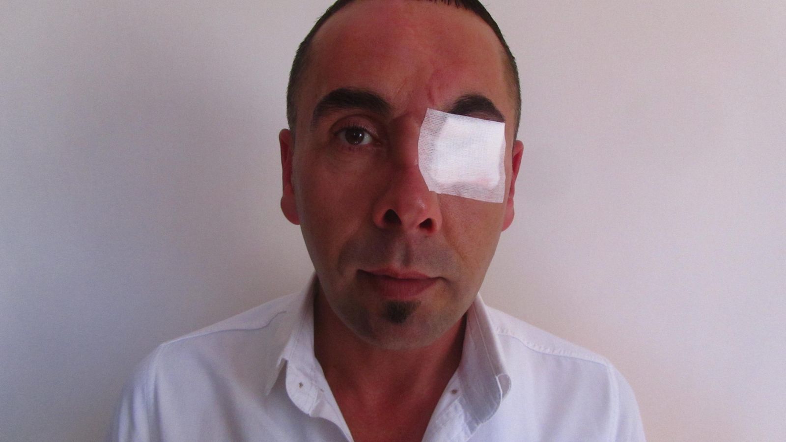 Foto: Hakan Yaman, a quien un policía turco sacó un ojo con un hierro durante la revuelta de Gezi en 2013 (D. Iriarte)