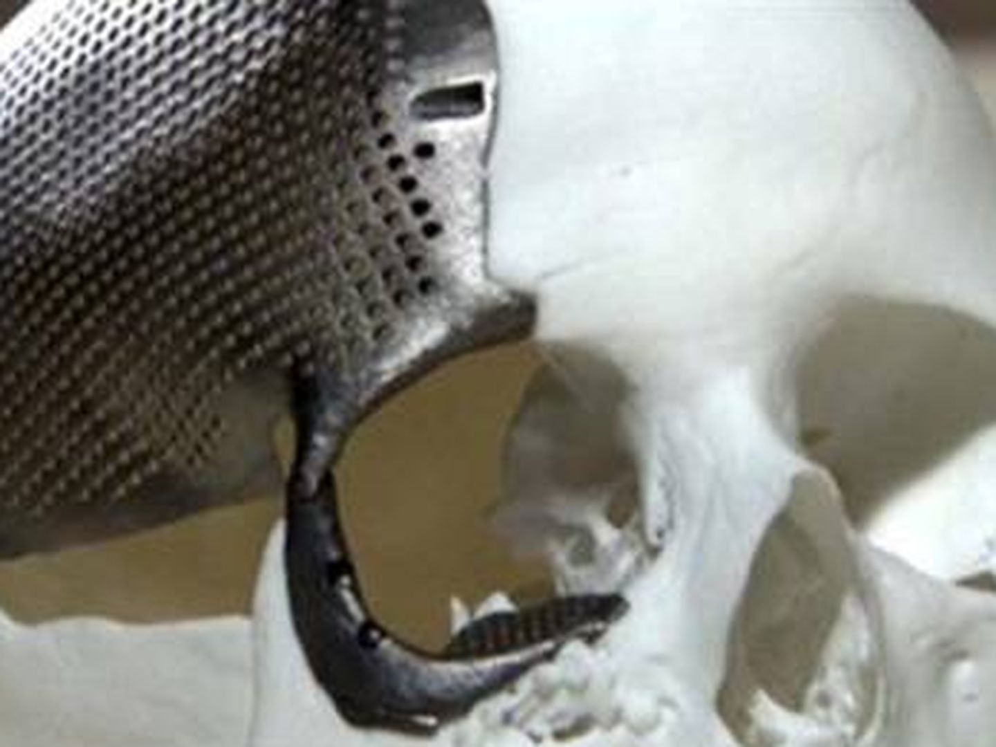 Implante realizado en impresión 3D con titanio. (Embodi3D)