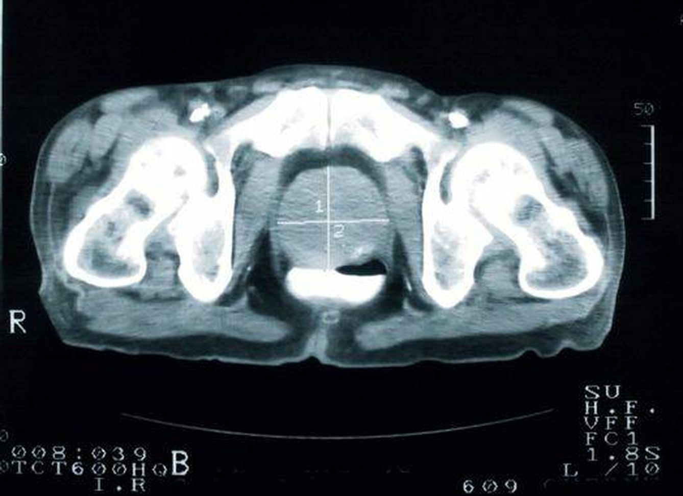 Imagen radiológica de una próstata. (iStock)