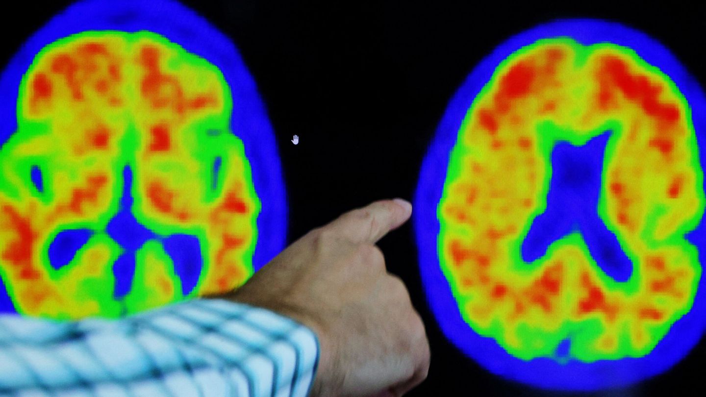 Alzhéimer detectado por técnicas de neuroimagen. (Reuters)