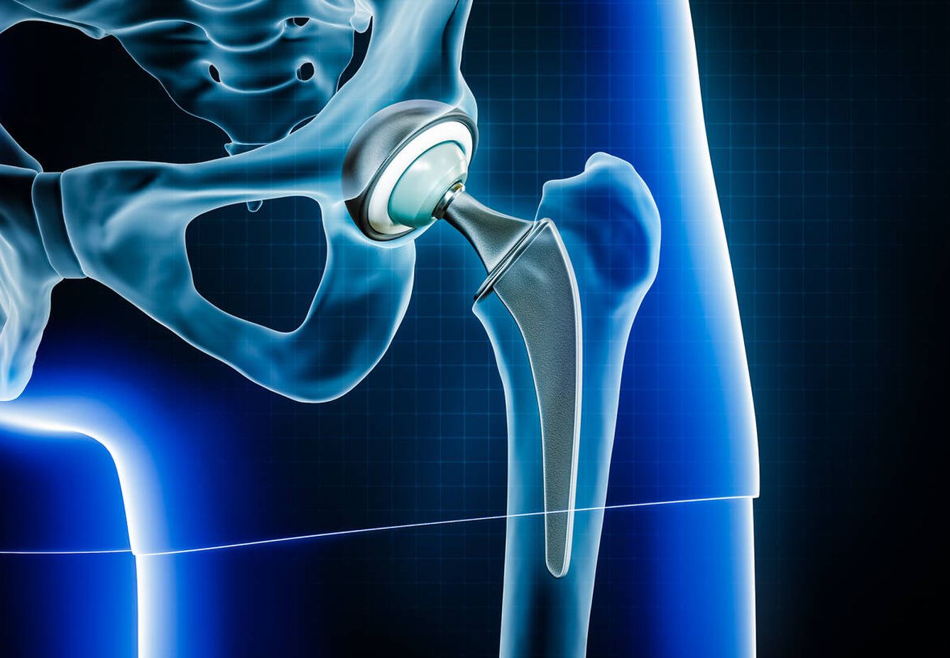 La radiografía muestra la prótesis de cadera. (iStock)