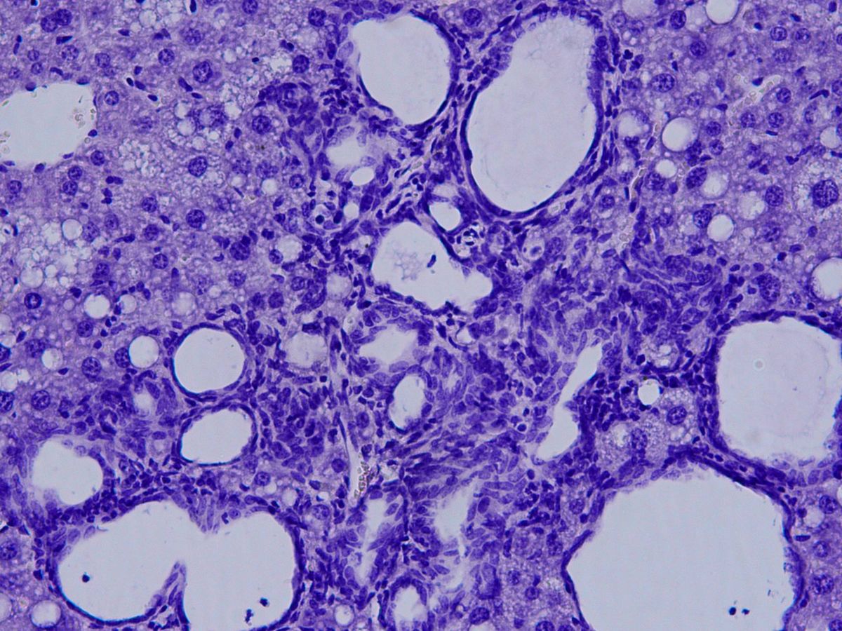 Foto: Colangiocarcinoma visto al microscopio. (CNIC)