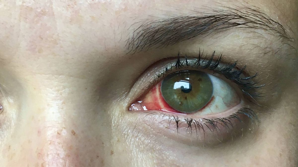 Un adolescente pierde parte de la retina por culpa de un puntero láser