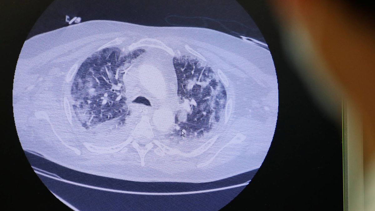 Las primeras autopsias del covid-19 revelan un 'thriller' microbiológico en los pulmones