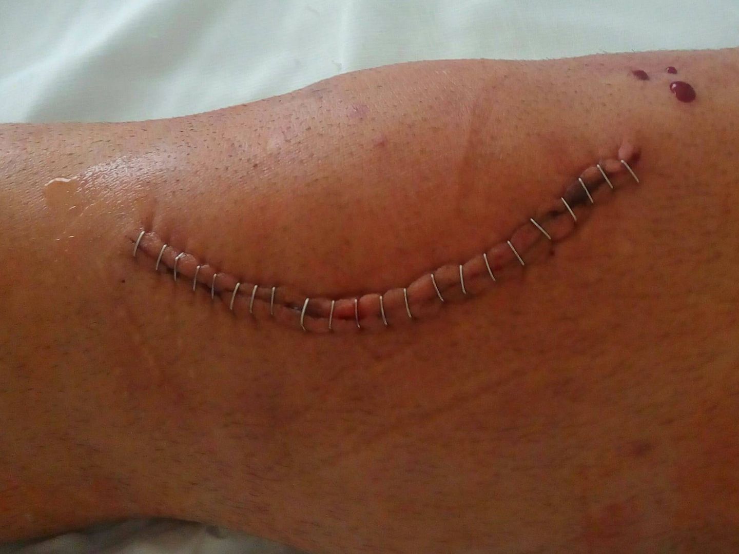 Imagen de la rodilla de Alejandro después de una de las operaciones.