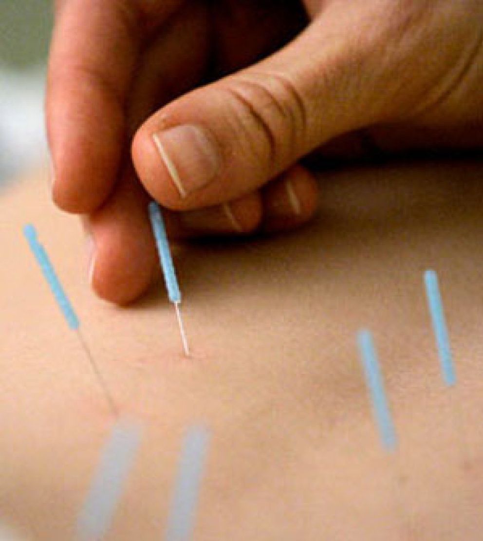 Foto: La acupuntura puede combatir la alergia al polen