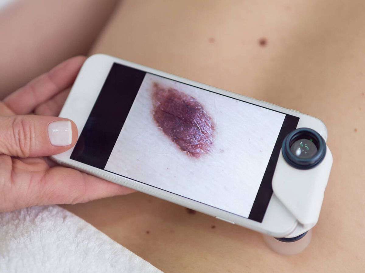Foto: El melanoma es un cáncer de piel grave y poco frecuente (Foto: iStock)