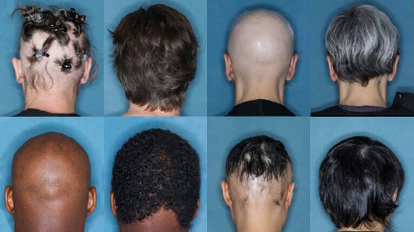 Sujetos con alopecia areata tratados con baricitinib. (Universidad de Yale)