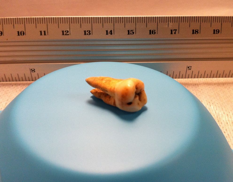 Unos de los dientes de los que se ha extraído el patógeno. (Universidad McMaster)