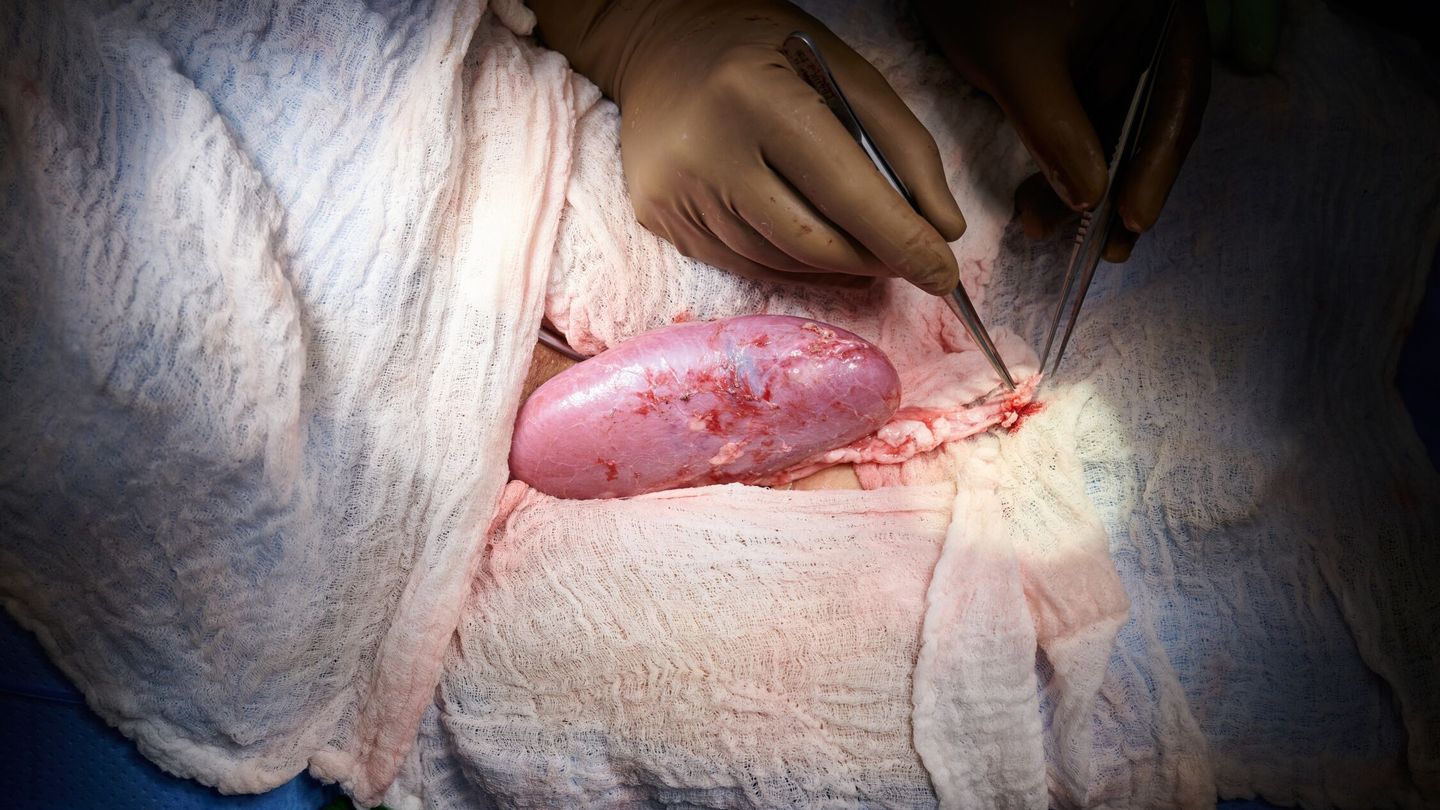 El riñón de cerdo utilizado en un trasplante humano en NY. (EFE)