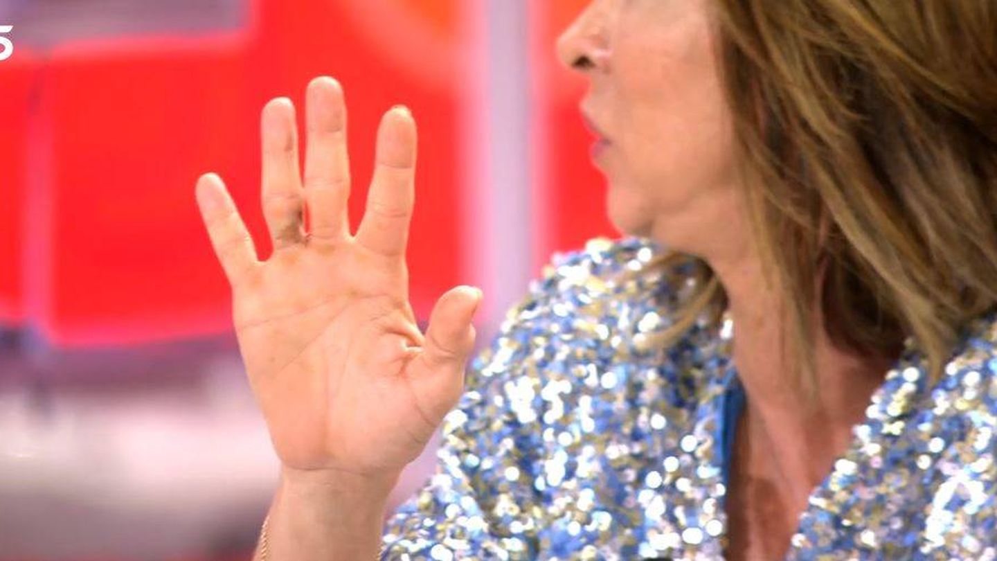 María Patiño muestra su mano lesionada. (Telecinco)