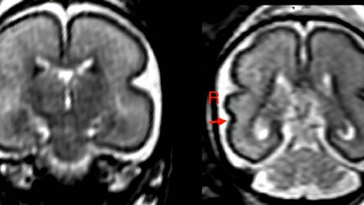 Cerebro fetal después de la exposición intrauterina al alcohol en fetos entre 25 y 29 semanas de gestación.