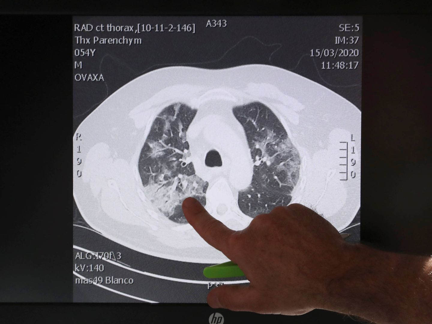 Un médico belga señala los pulmones de un paciente con covid-19 en el hospital belga de Aalst. (Reuters)
