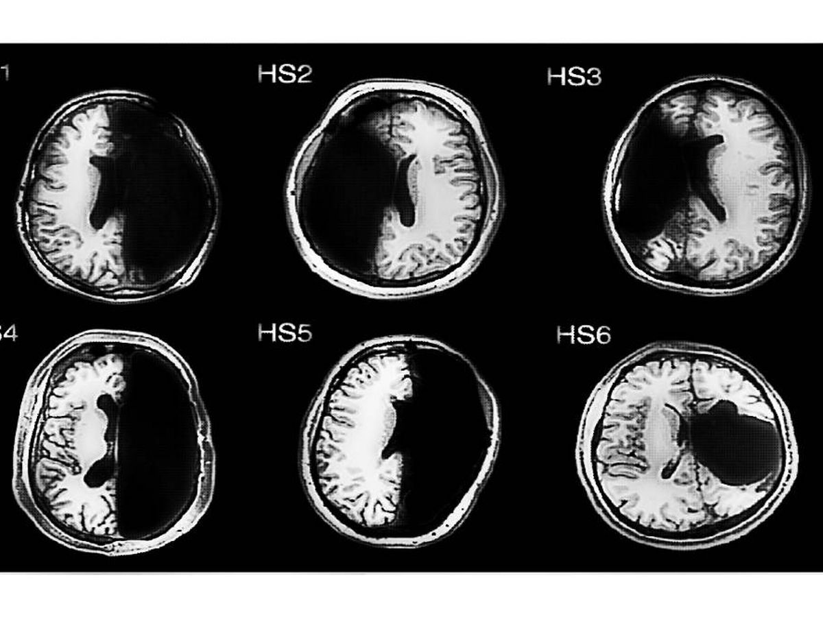 Foto: Cerebros pasados por una hemisferectomía. (Montaje: EC)