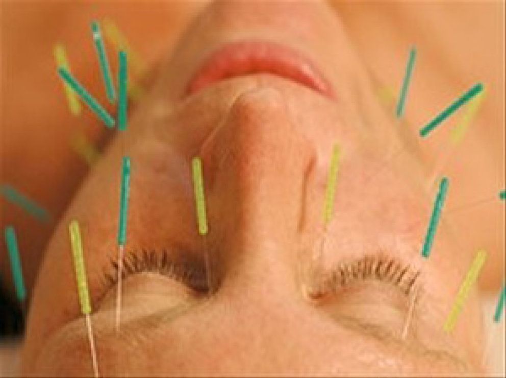 Foto: La acupuntura tradicional ayuda a aliviar la migraña