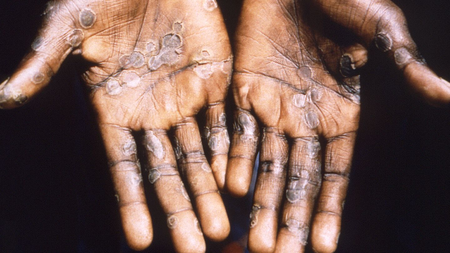  Imagen de las lesiones en la piel provocadas por la viruela del mono, durante un estudio llevado a cabo en la República Democrática del Congo entre los años 1996 y 1997. (EFE/Brian)