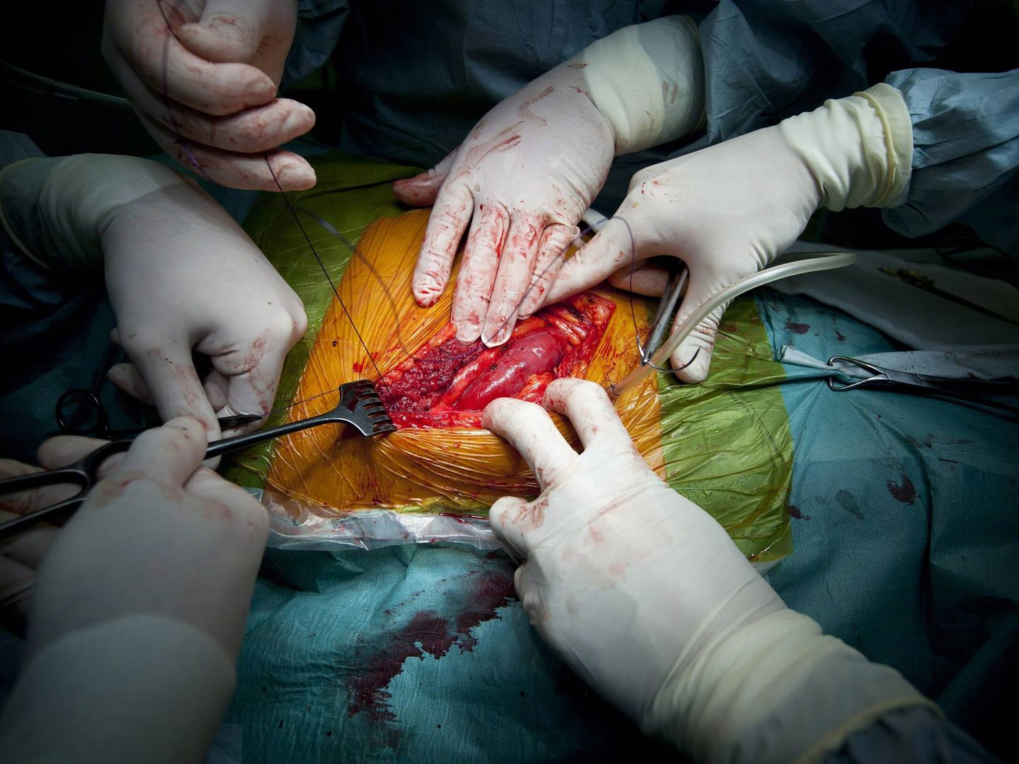 Varios cirujanos trabajan en una operación de transplante de riñón de un donante vivo en el hospital universitario Semmelweis de Budapest, Hungría.  (EFE/Balazs Mohai)