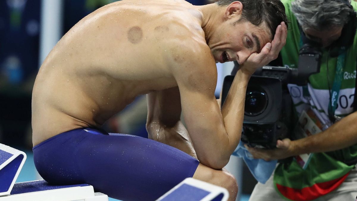 ¿Qué son los extraños moratones en la espalda del nadador Michael Phelps? 