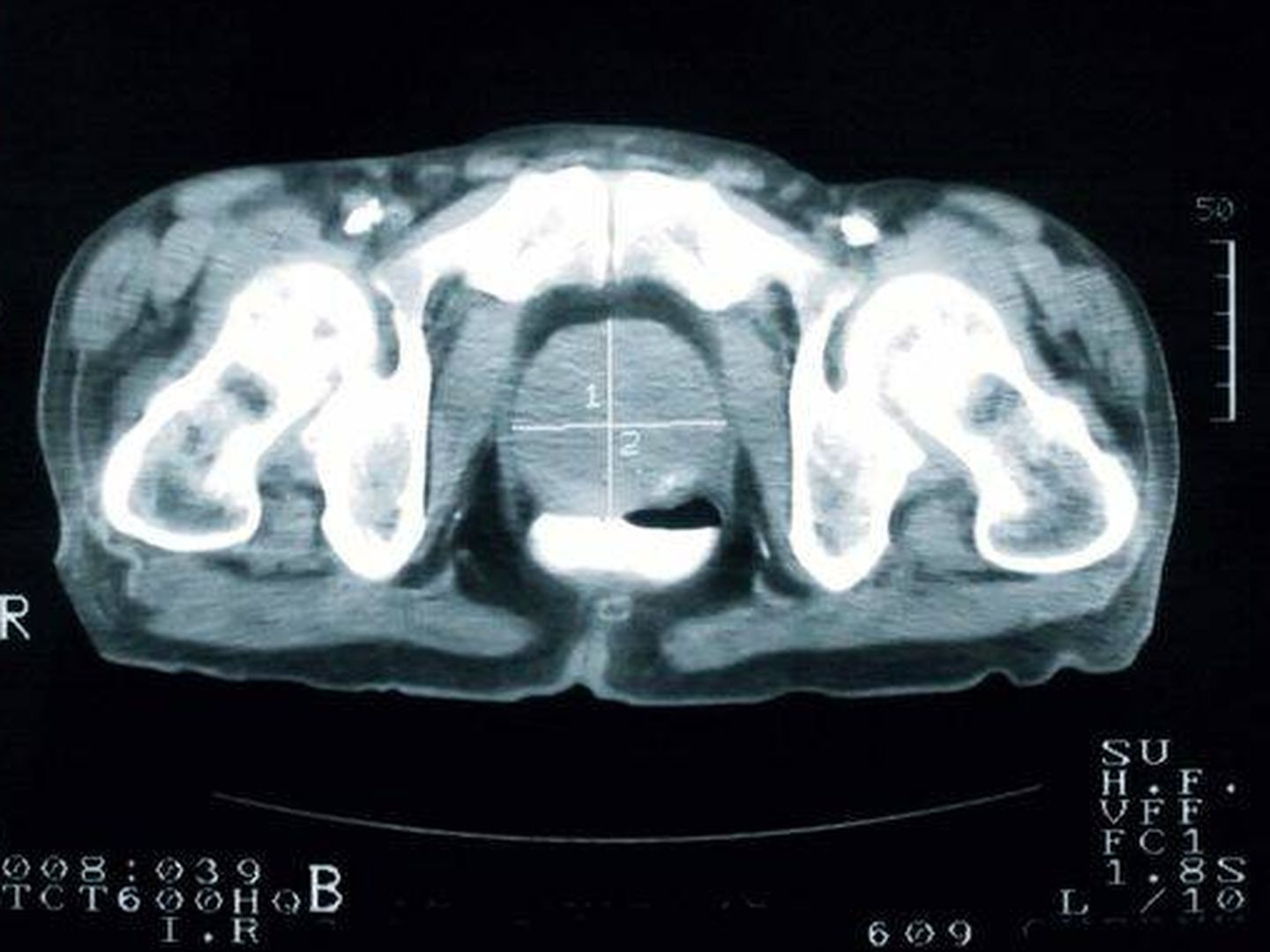Imagen radiológica de una próstata. (iStock)