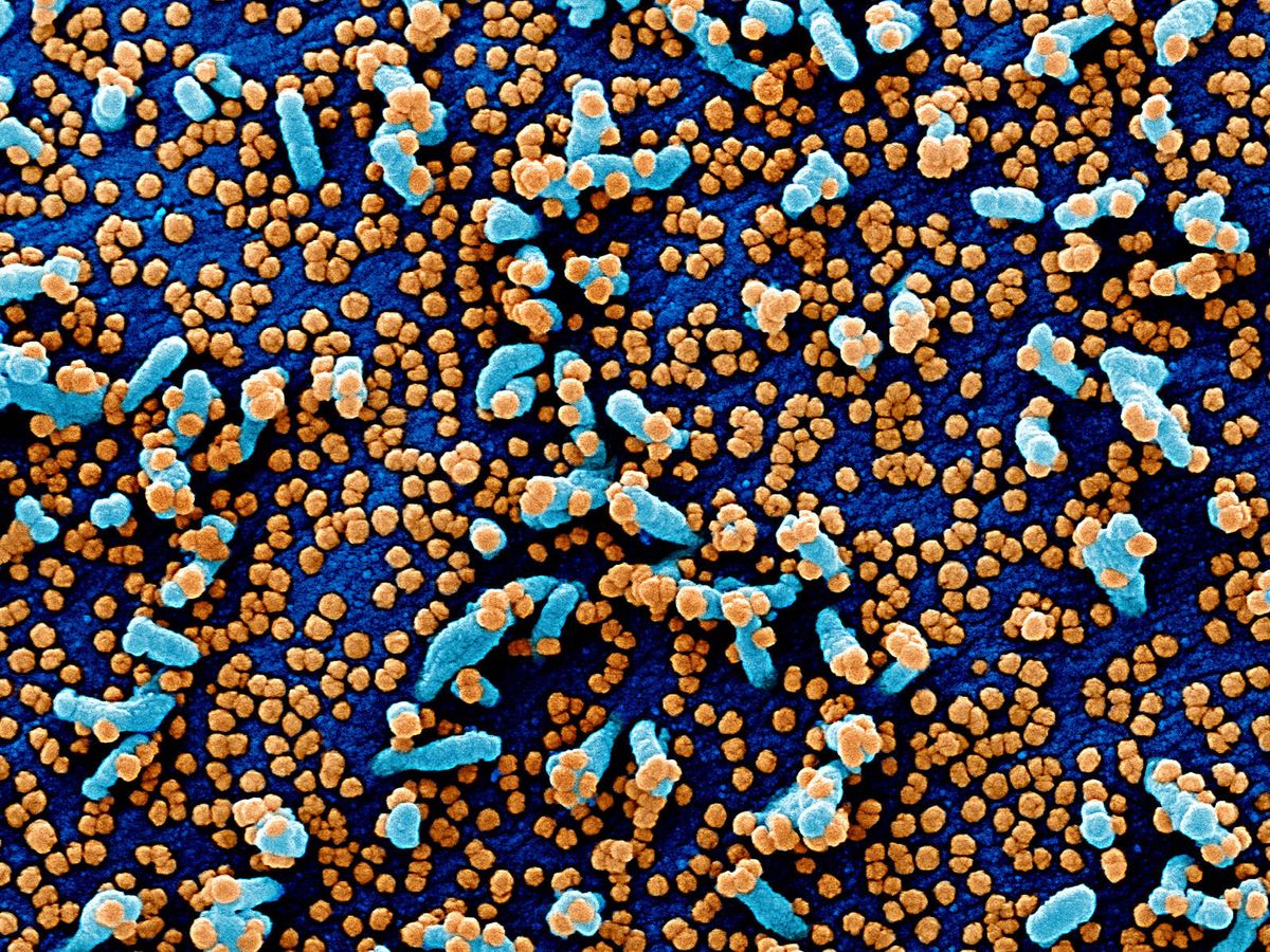 Foto: Células VERO E6 (en azul) gravemente afectadas por SARS-CoV2 (en naranja), imagenes capturas de un paciente ingresado.