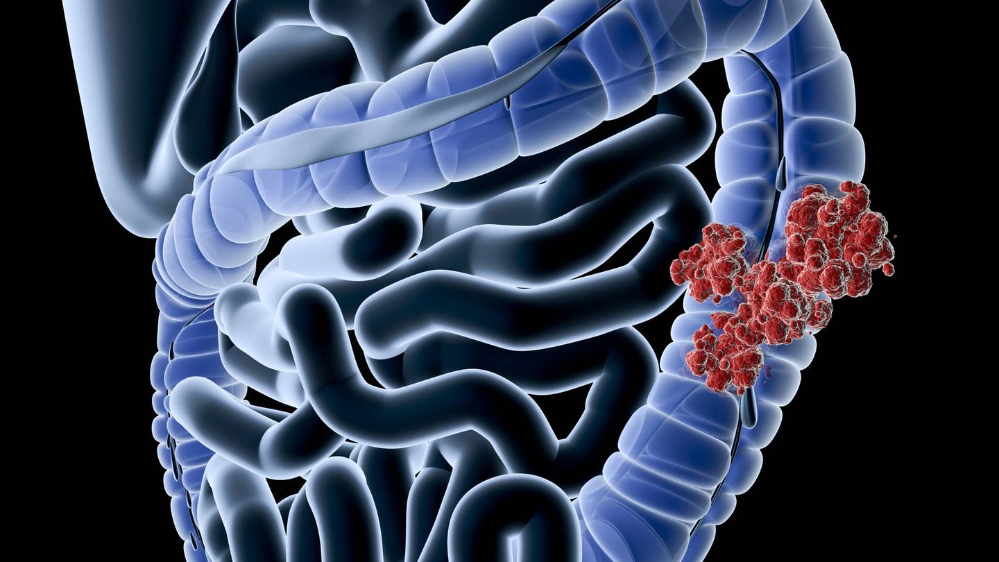 Ilustración del cáncer de colon. (iStock)