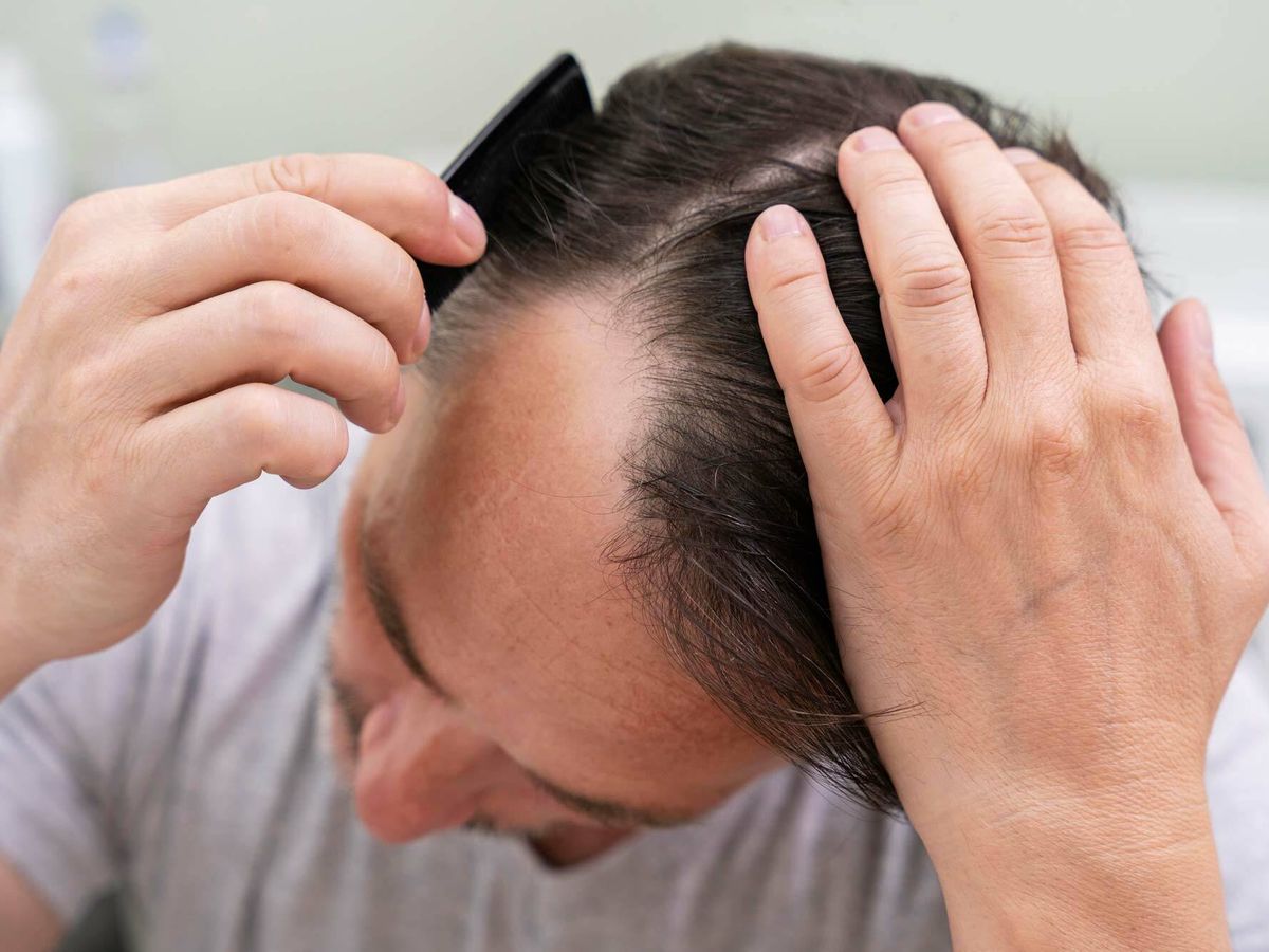Foto: Los cambios de estación o el estrés son causas habituales de pérdida de cabello (Freepik)
