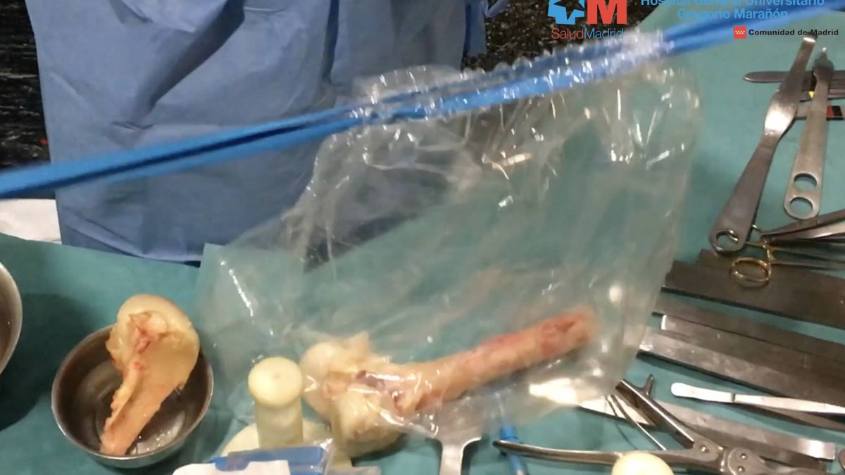 Orfebres del banco de huesos: así se talla la pelvis de un cadáver para mejorar una vida