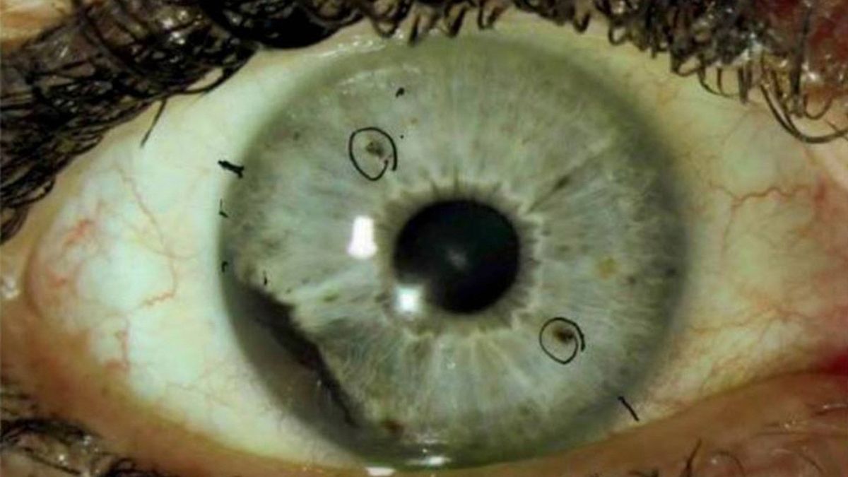 Los treinta misteriosos casos de cáncer de ojo que los médicos no  han logrado explicar  