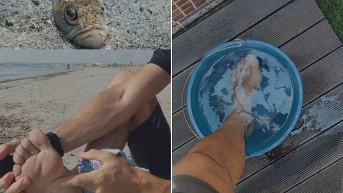 Este sanitario te explica qué hacer si estás paseando por la playa y te pica un pez araña