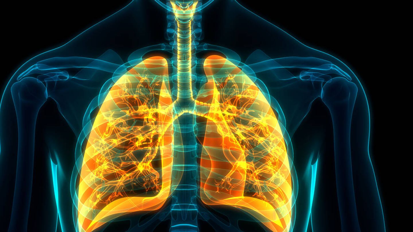 Pulmones afectados por enfermedad obstructiva crónica. (iStock)