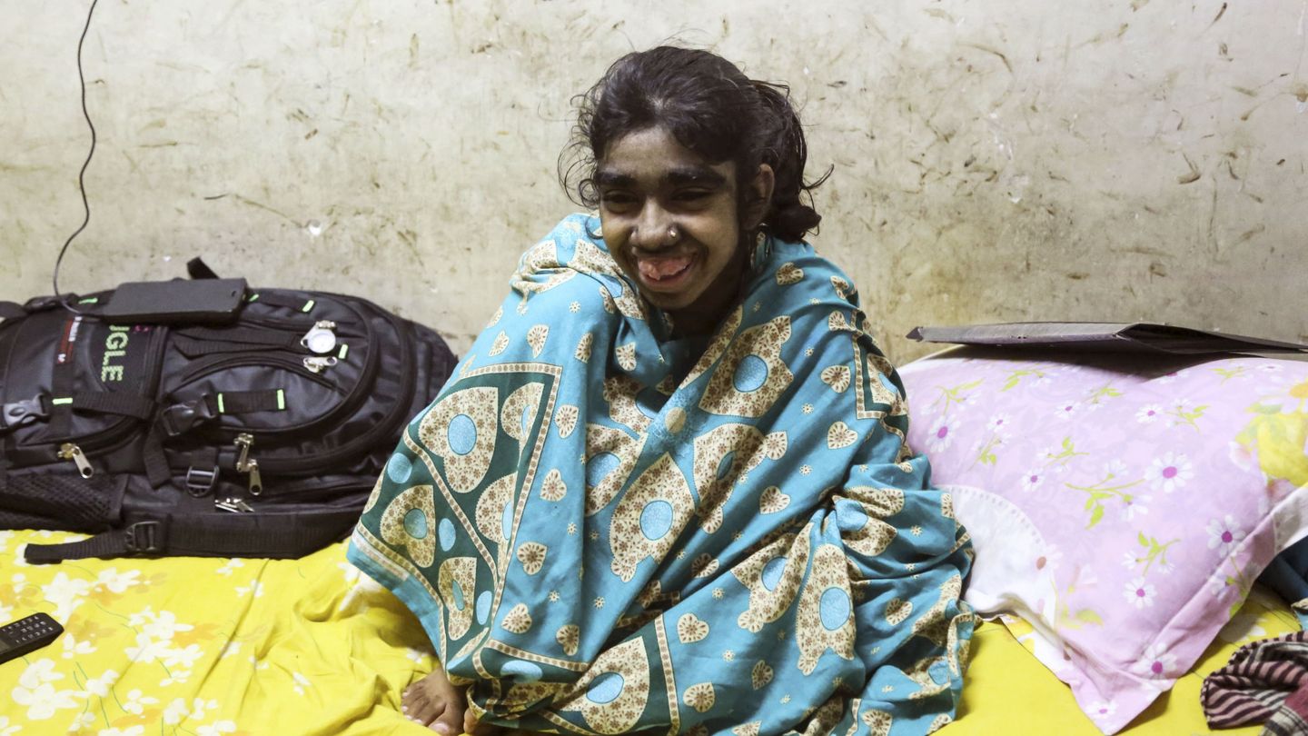 Una niña india afectada gravemente por el 'síndrome del hombre lobo' (EFE/Igor G. Barbero)