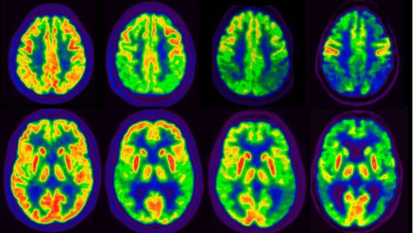 Diagnóstico de alzhéimer a través de la imagen mediante PET (tomografía de emisión de positrones)