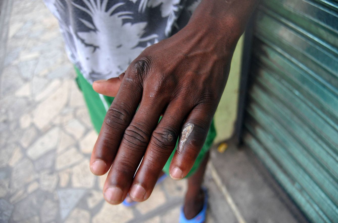 Senusi, de Guinea Bisáu, muestra la cicatriz que le dejó el machetazo de un traficante de personas (I. Savio)